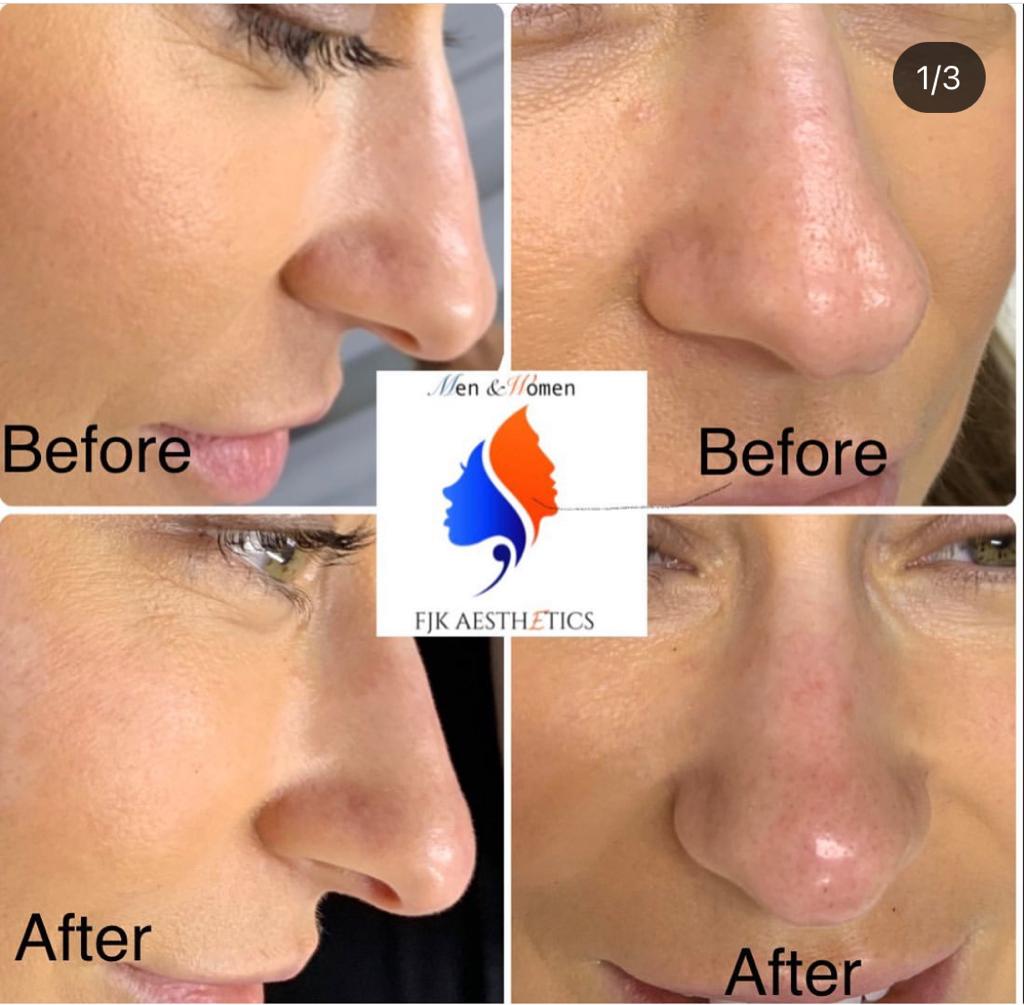 Non Surgical Rhinoplasty2