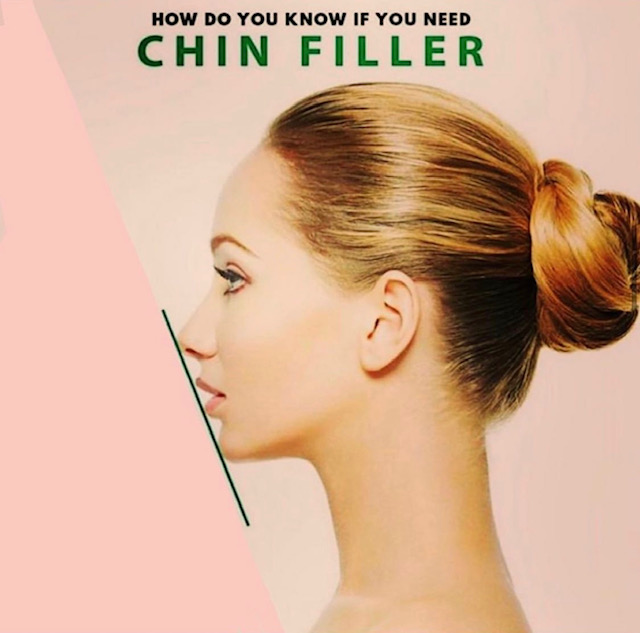 chin_filler4