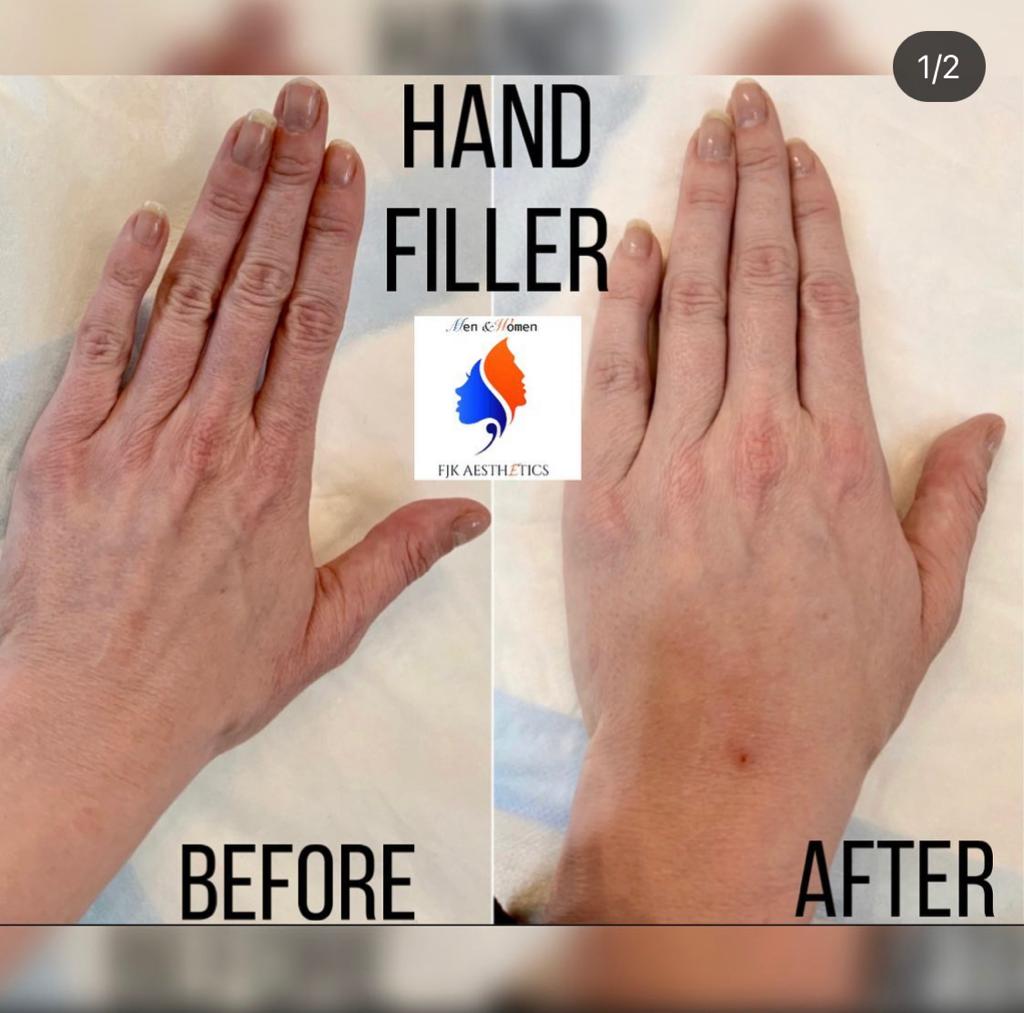 hand_filler1