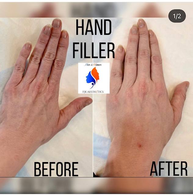 hand_filler3