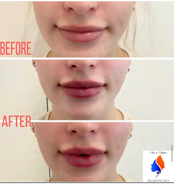 lip_fillers10