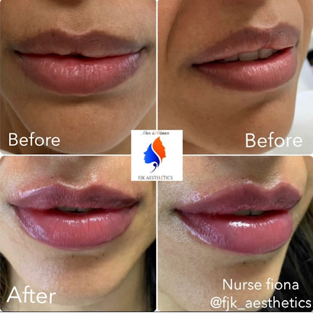 lip_fillers3