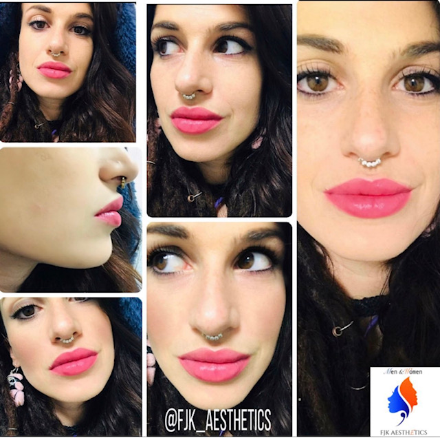 lip_fillers7