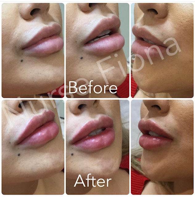 lip_fillers8