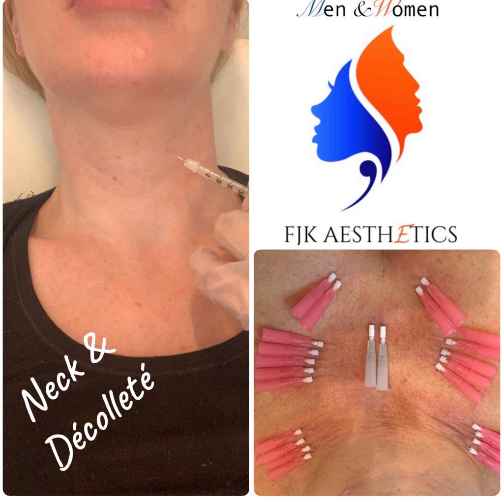 Neck and décolletage injections1