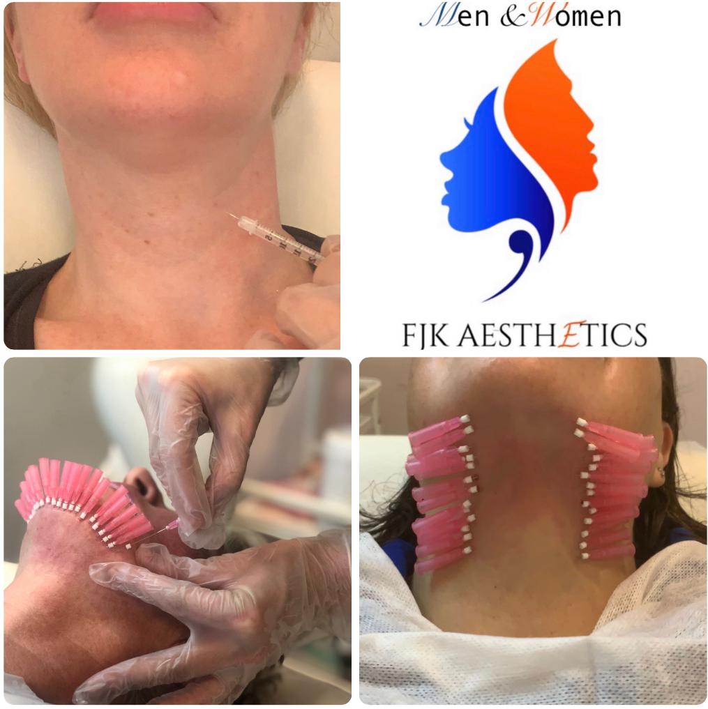 Neck and décolletage injections2