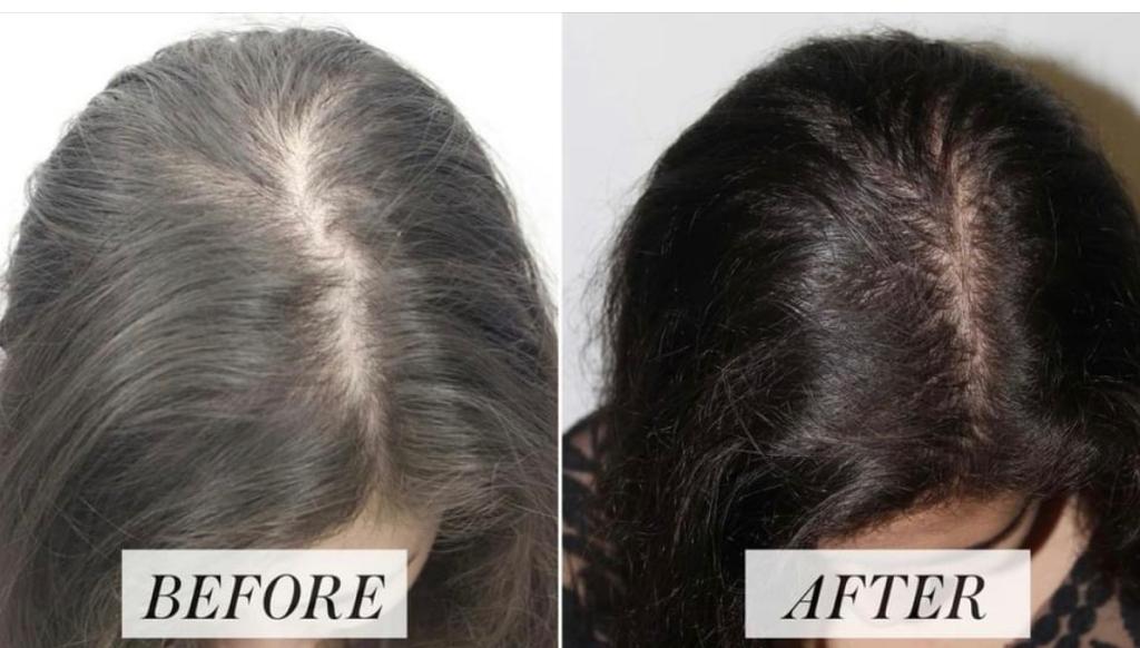 PRP hair restoration