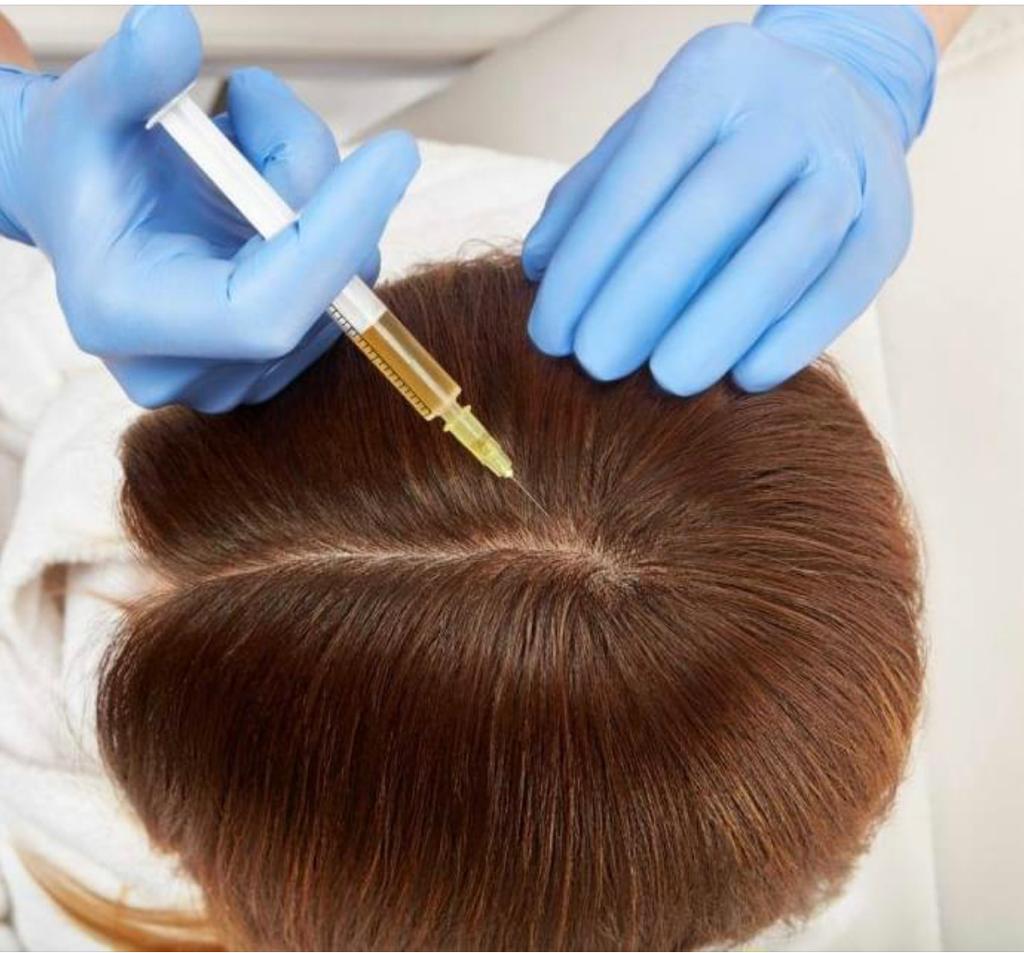 PRP hair restoration2